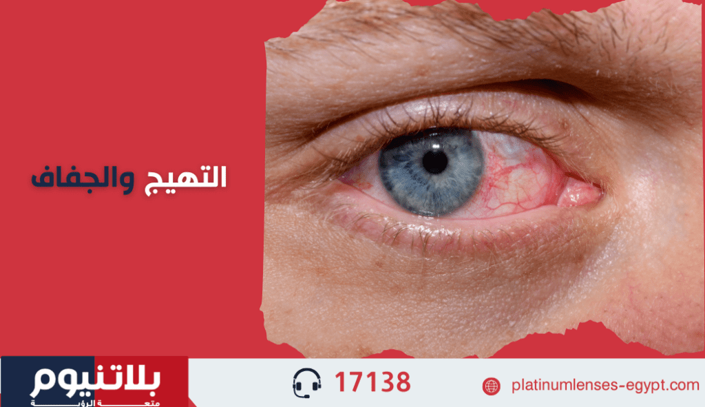 التهيج والجفاف للعين